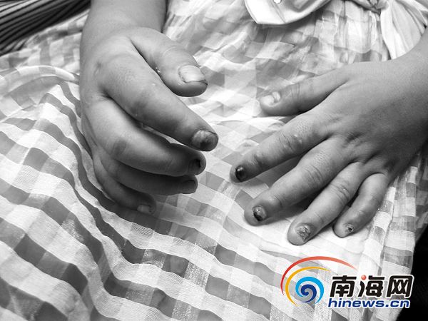 5龄女童寄养遭残忍虐待 多处被烟头烫伤<em>处女膜</em>
