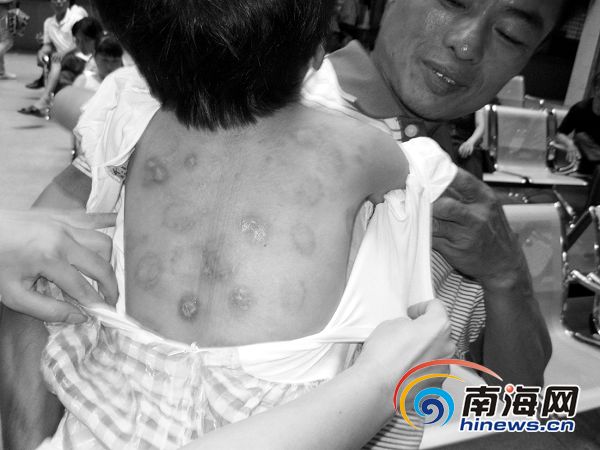5龄女童寄养遭残忍<em>虐待</em> 多处被烟头烫伤处女膜